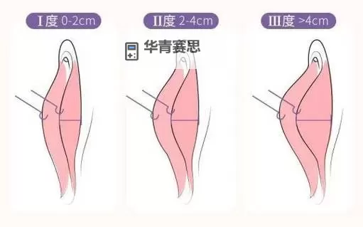 探秘正常阴唇的样子:照片与视频详解图1